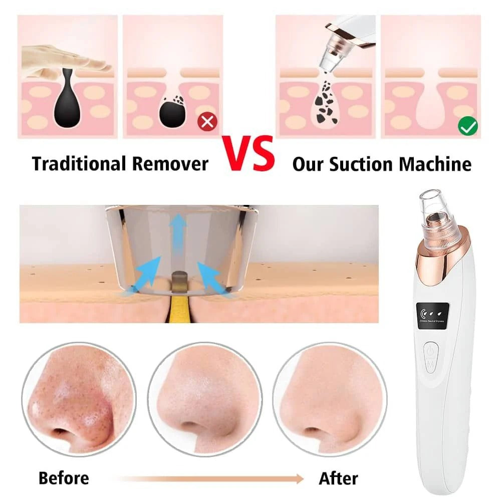 Blackhead Vacuum Remover — 5-Head Electric Pore Cleaner & Skin Exfoliator