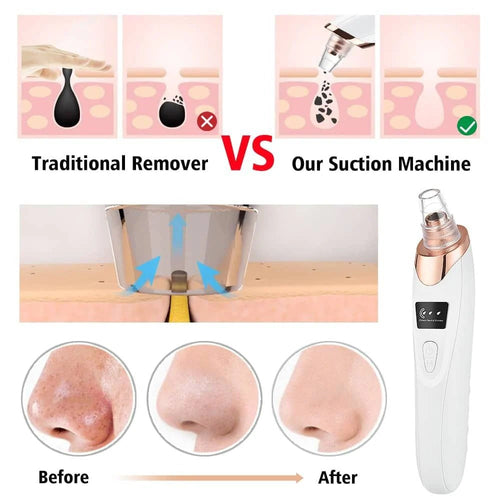 Blackhead Vacuum Remover — 5-Head Electric Pore Cleaner & Skin Exfoliator